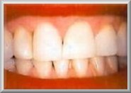 after tooth whitening